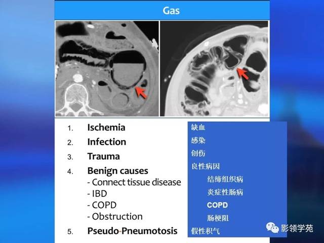 溃疡性结肠炎ct