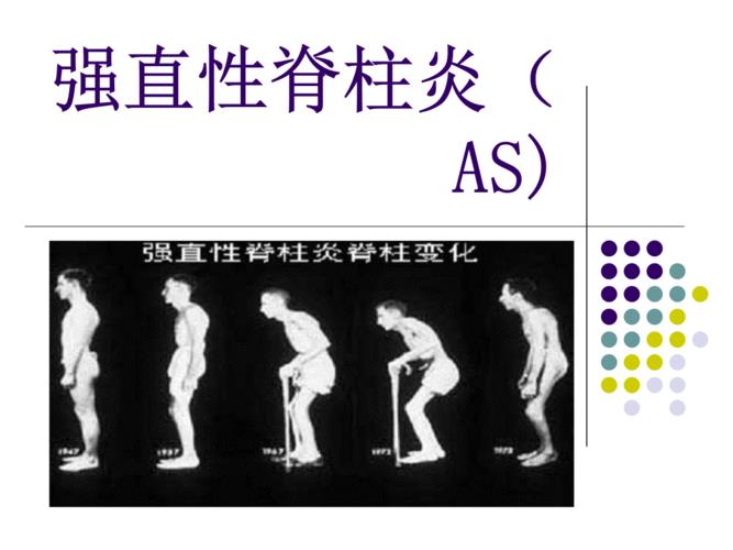 10年能攻破强直性脊柱炎吗