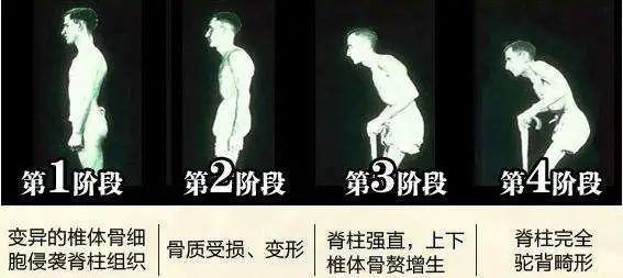 强直性脊柱炎发病特点