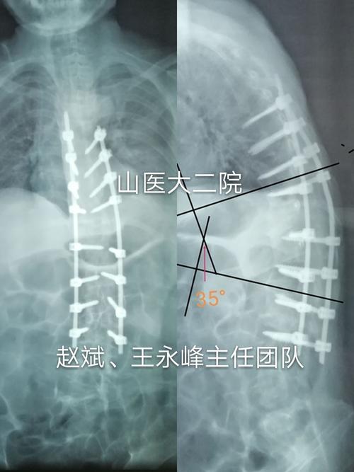 强直性脊柱炎去医院治疗