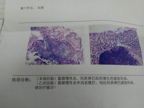 溃疡性乙状结肠炎肚子疼吗