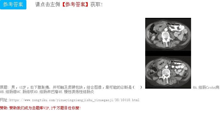 溃疡性结肠炎x造影表现