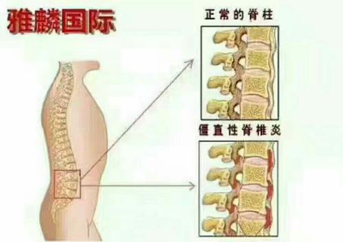 强直性脊柱炎照片