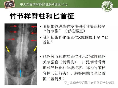 强直性脊柱炎分期分型