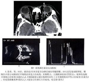 霍奇金淋巴瘤