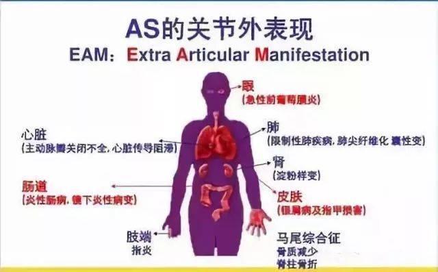 为什么强直性脊柱炎拉肚子