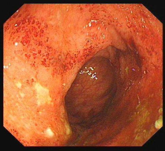 溃疡性结肠炎如何检查