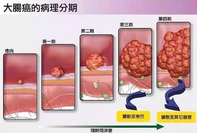 甲状腺和溃疡性结肠炎有关系吗