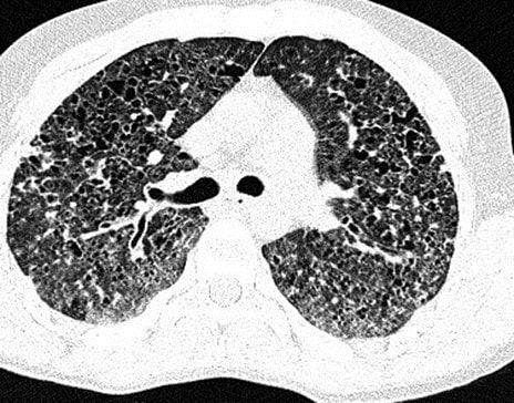肺囊性纤维化