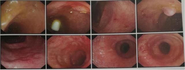肠镜鉴别溃疡性结肠炎
