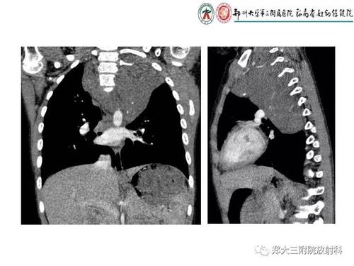 神经母细胞瘤