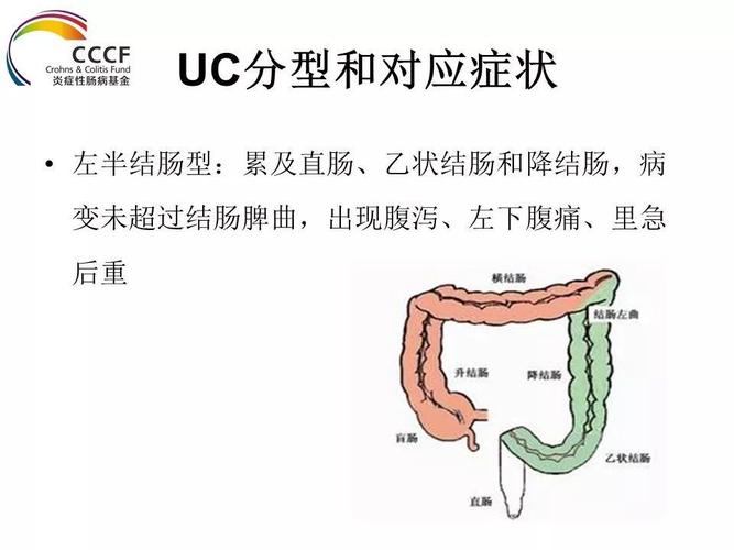 溃疡性结肠炎是一种