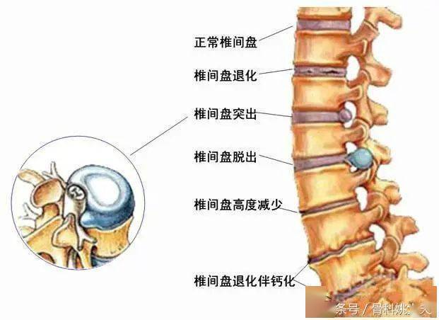 脊柱结核会不会误诊强直性脊柱炎