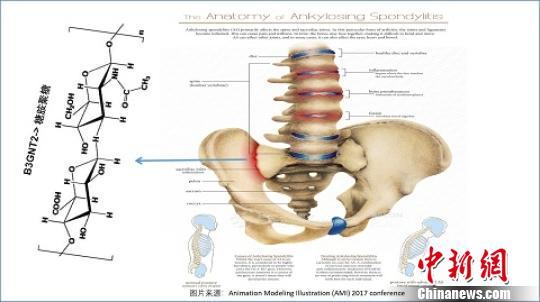 强直性脊柱炎基因