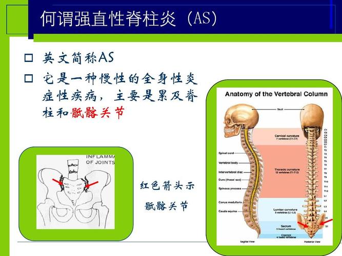 强直性脊柱炎骶髂骨到脚发热