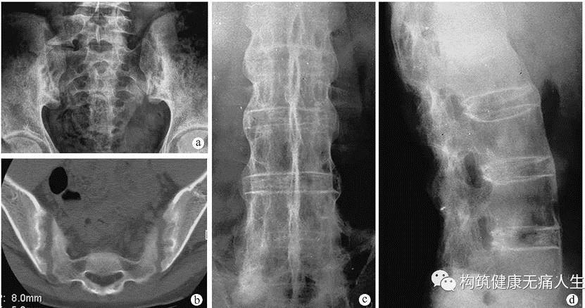 强直性脊柱炎引起的腰部僵硬