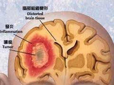 脑胶质瘤