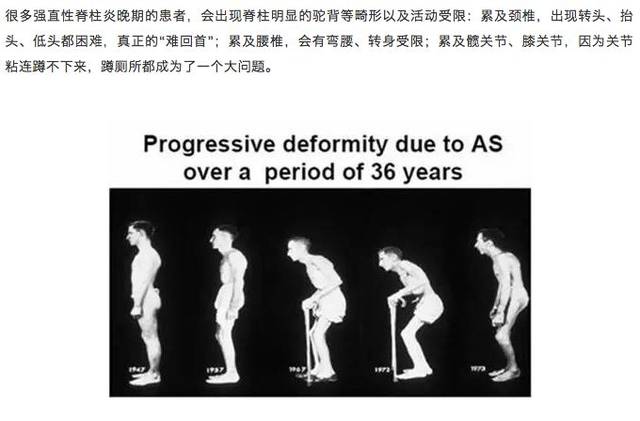 偏瘫强直性脊柱炎最新治疗