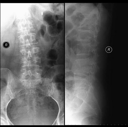 强直性脊柱炎x线表现