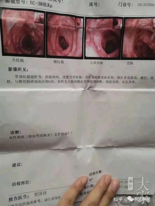 溃疡性结肠炎症状腹痛严重吗