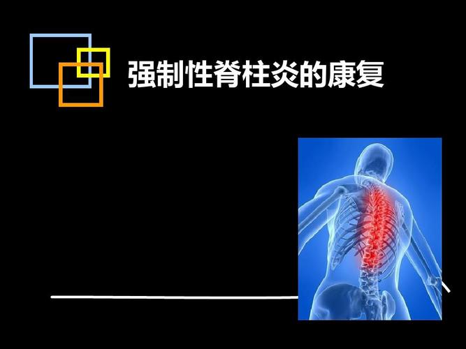 强直性脊柱炎外周关节炎正确特征