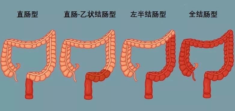 慢性溃疡性结肠炎和直肠炎