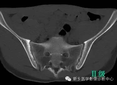 强直性脊柱炎骶髂关节发炎疼痛