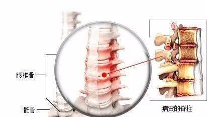 强直性脊柱炎为什么会引起瘫痪