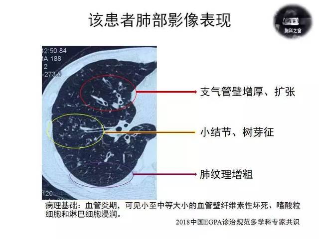 巨细胞动脉炎和强直性脊柱炎