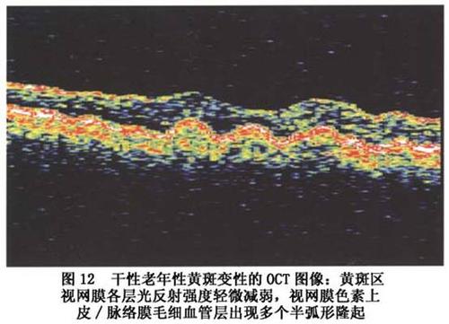 湿性黄斑变性