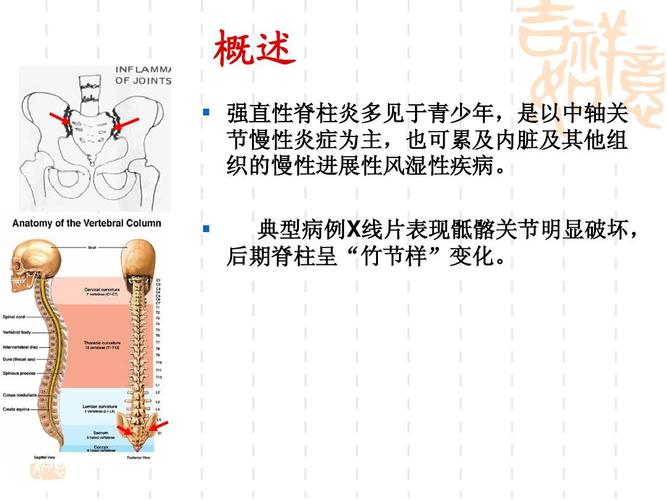 骶髂关节1级是不是强直性脊柱炎