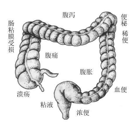 溃疡性结肠炎反复发烧怎么治疗