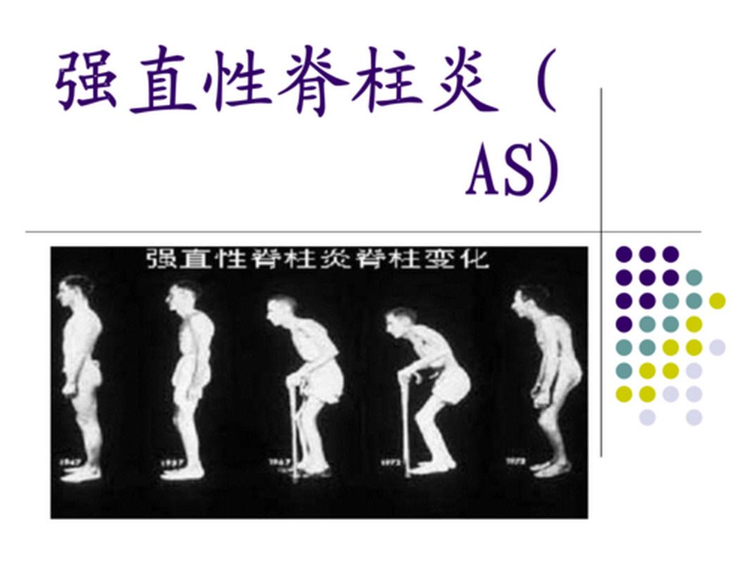 强直性脊柱炎的症状阶段