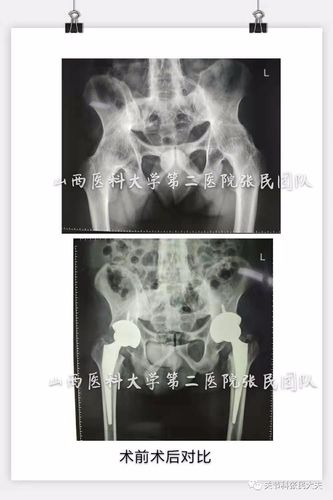 强直性脊柱炎髋关节外侧痛