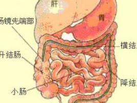 溃疡性结肠炎吃肠炎宁