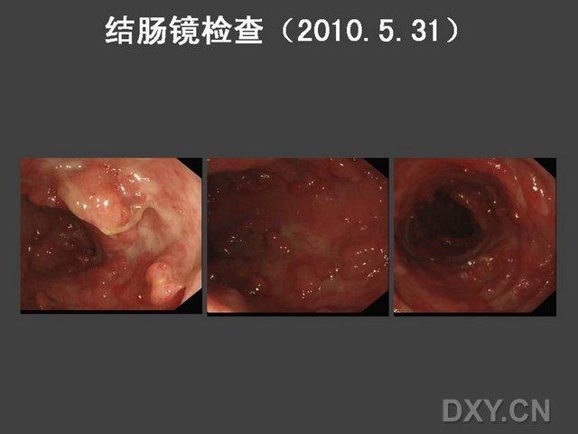 几味药治好了多年的溃疡性结肠炎