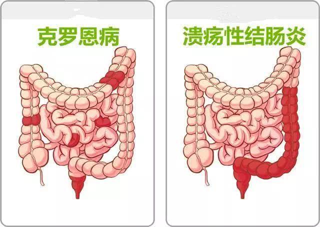 溃疡性结肠炎直肠炎