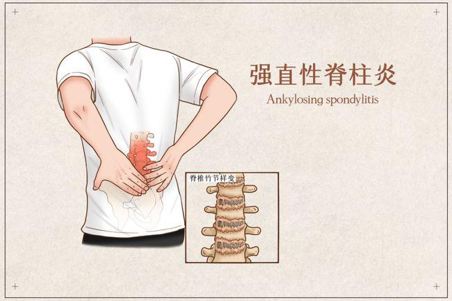 强直性脊柱炎检查那几项