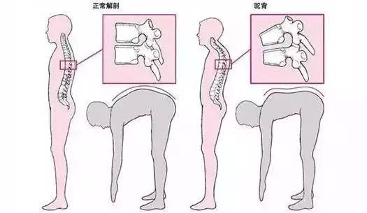 强直性脊柱炎早期会不会驼背