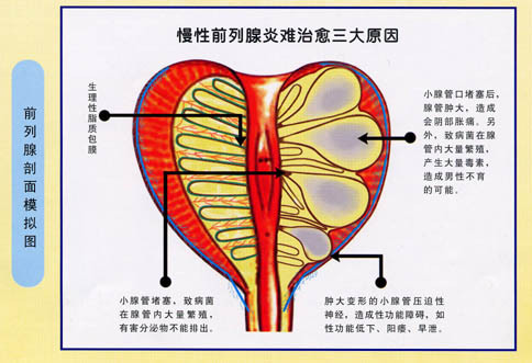 膀胱癌