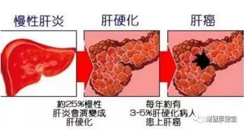 细胞溃疡性结肠炎症状