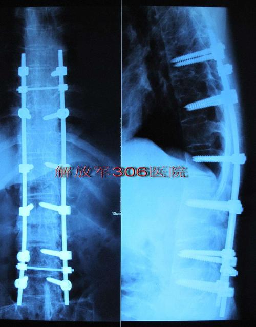 强直性脊柱炎在国内的现状