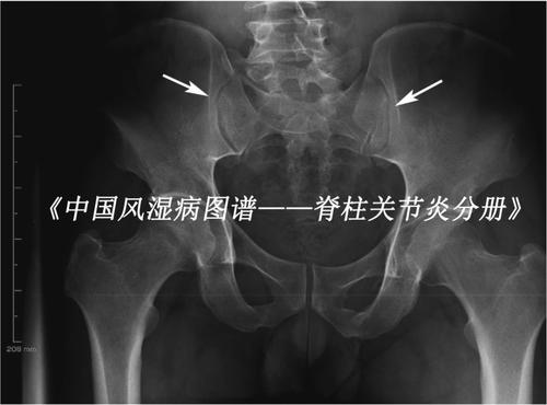 强直性脊柱炎纽约分级