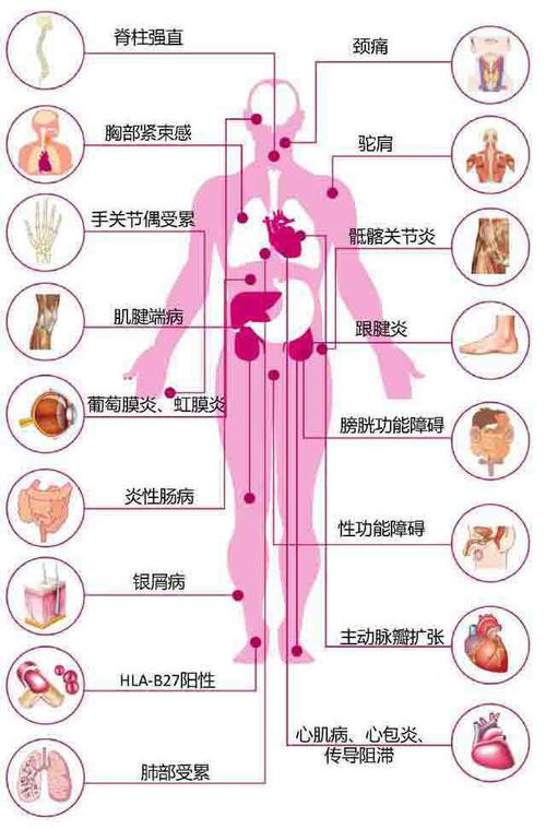 美沙拉秦治强直性脊柱炎吗