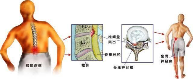 强直性脊柱炎冬天晚上腰疼怎么办