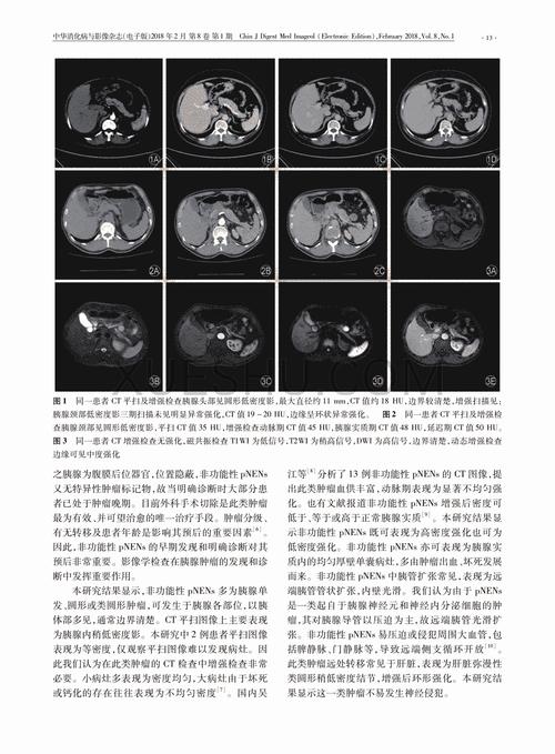 胰腺神经内分泌肿瘤