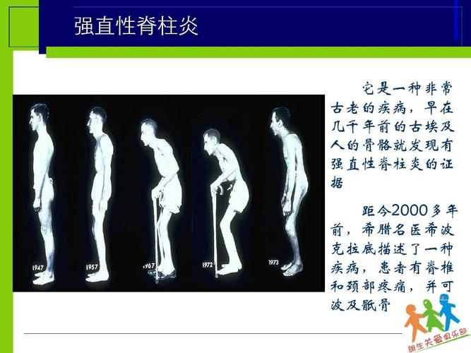 强直性脊柱炎不吃药怎么治疗