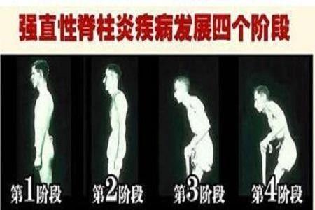 女人强直性脊柱炎为啥比男人轻