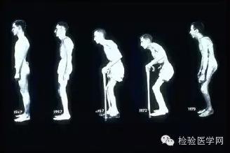 强直性脊柱炎检查b27是阴性