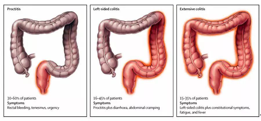 溃疡性结肠炎一星期流一次鼻血